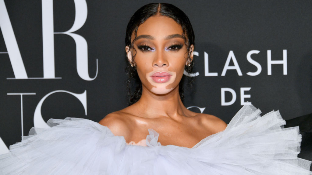 Breaking Beauty Taboos: The Story of Winnie Harlow